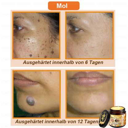 ADNOON®🌐Bienengift All-in-One Pflegecreme—👨🏻‍⚕️Empfohlen von der DDG 🥇🥇